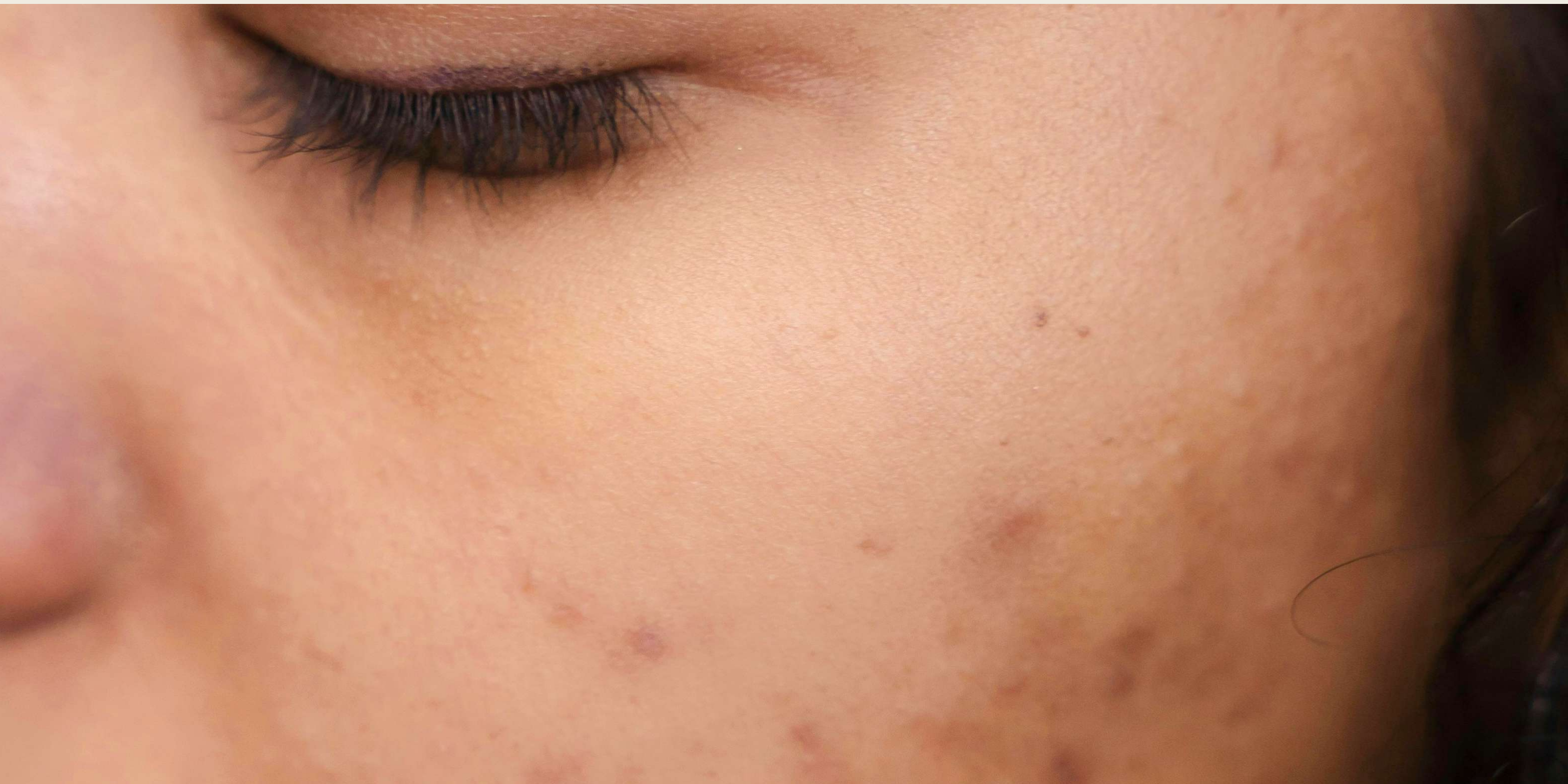 Unreinheiten, Hautbild, HEJ ORGANIC