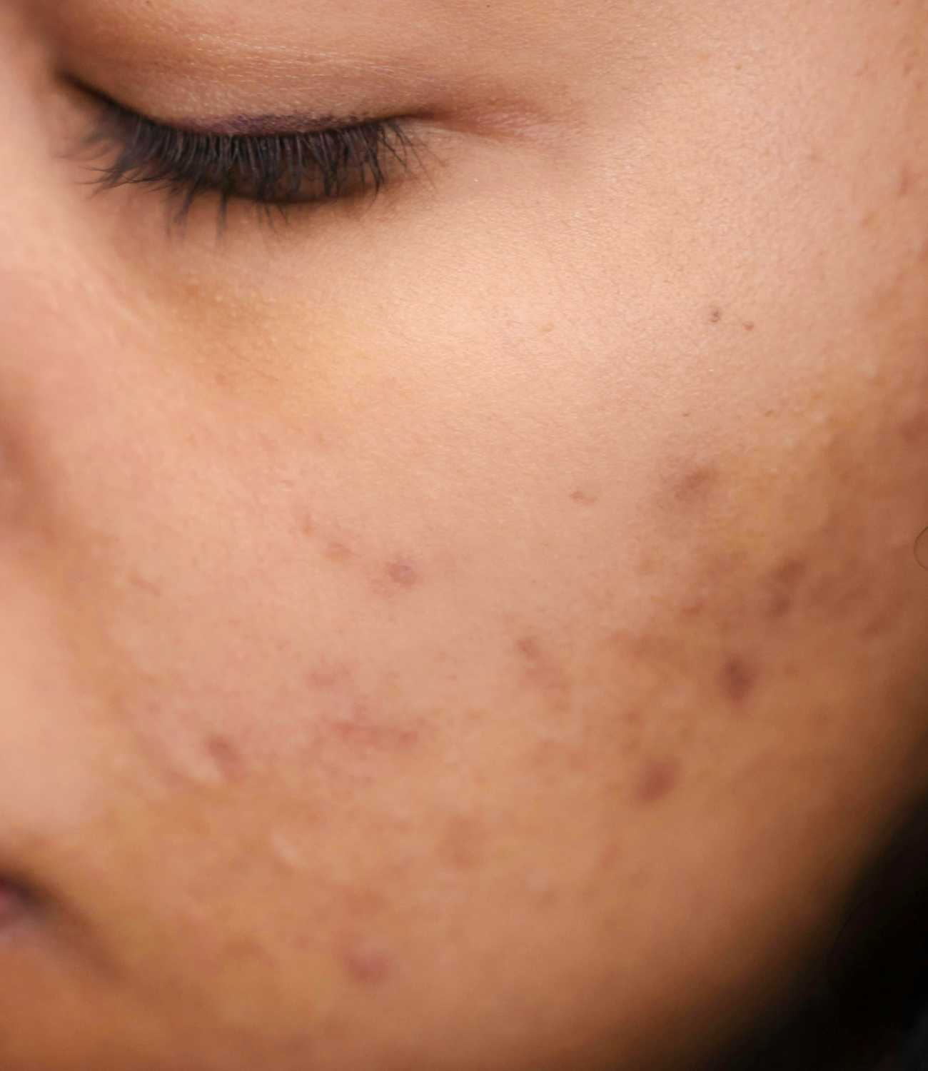 Unreinheiten, Hautbild, HEJ ORGANIC